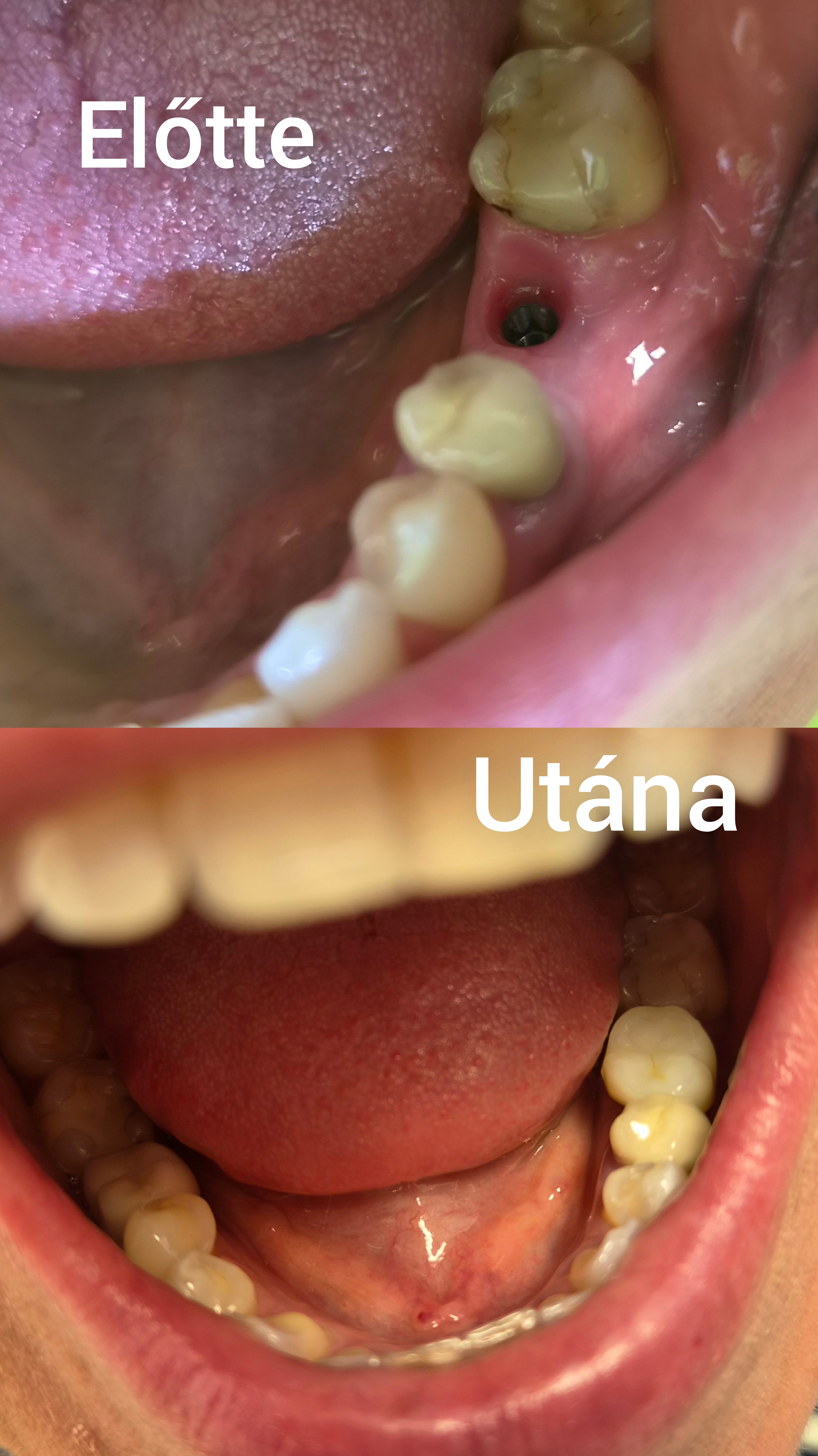 Esztétikus fogpótlás implantátummal