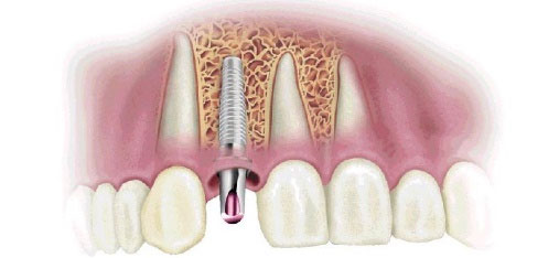 fogászati implantátum debrecen